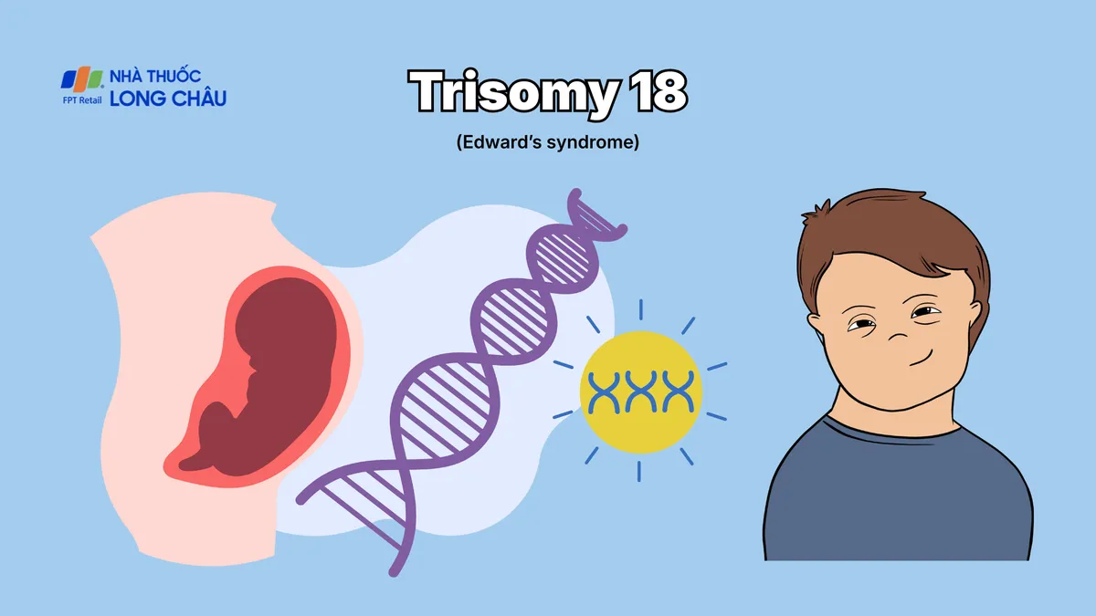 Hội chứng Trisomy 18: Nguyên nhân, chẩn đoán và mức độ ảnh hưởng đến trẻ