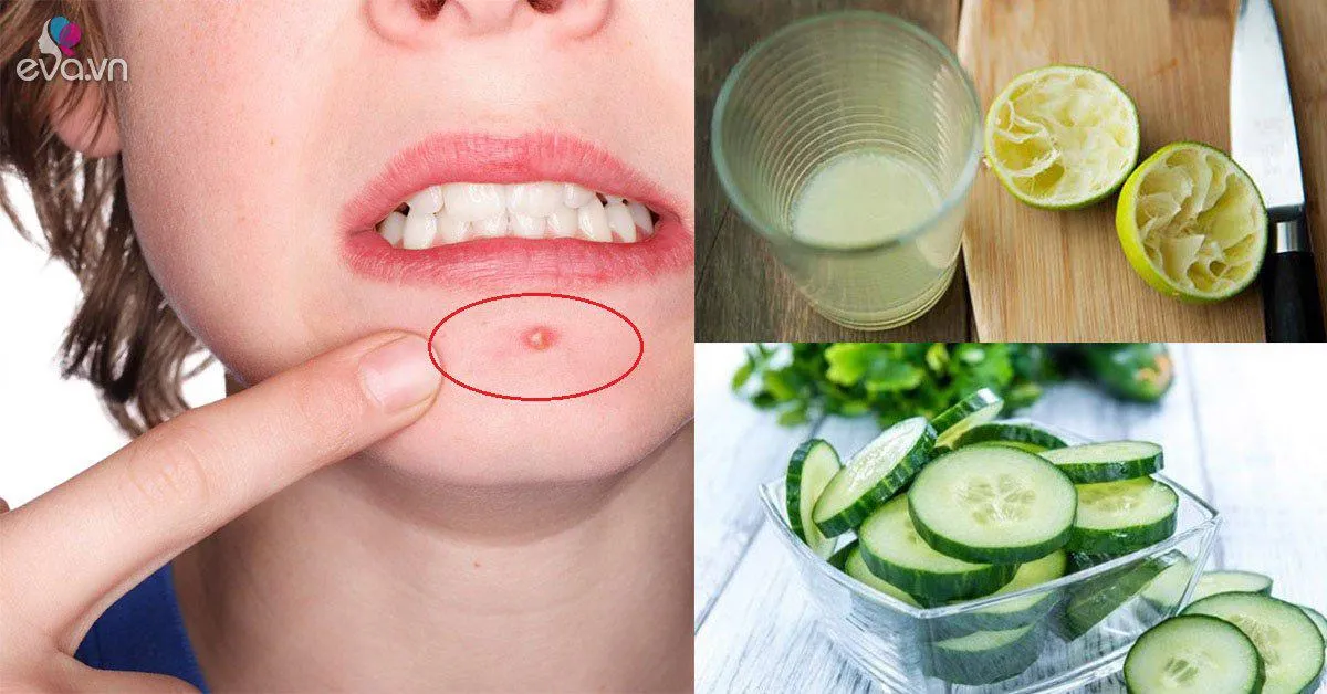 Với 5 ngàn đồng có ngay cách trị mụn bọc ở cằm hiệu quả chỉ sau 1 tuần
