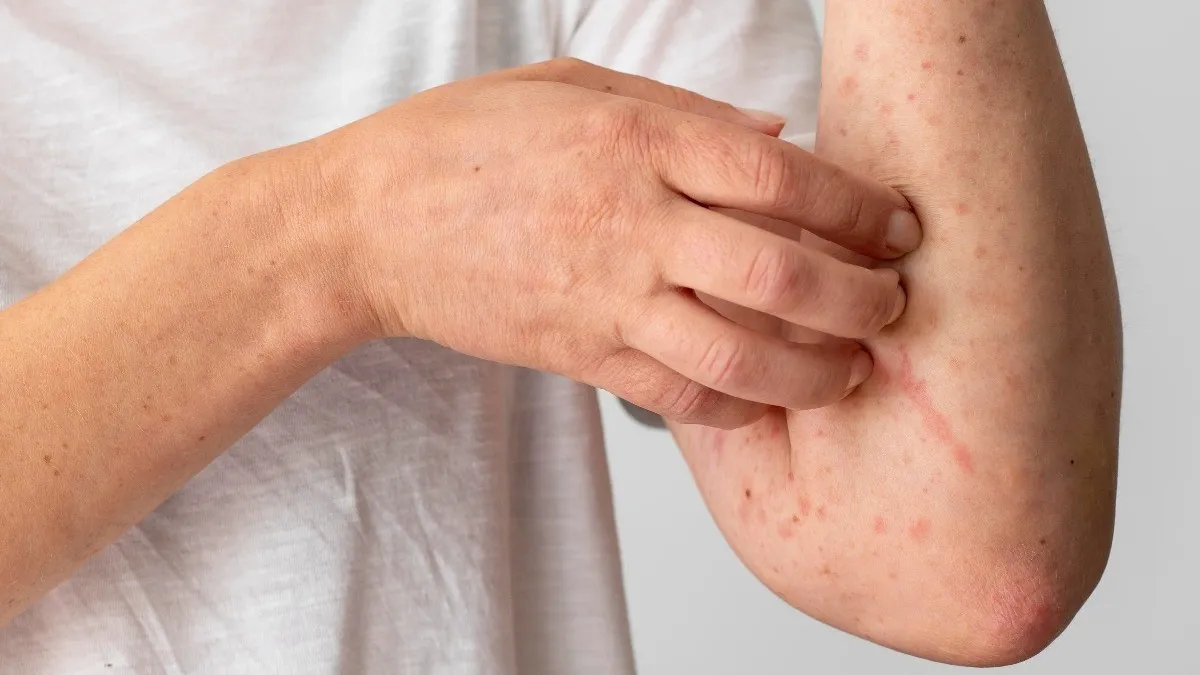 Cảnh báo viêm da dị ứng thời tiết: Lý do gây bệnh và cách xử lý