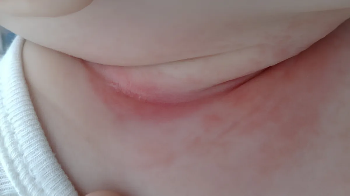 Nguyên nhân khiến trẻ sơ sinh bị nổi mẩn đỏ ở cổ và cách xử lý đúng