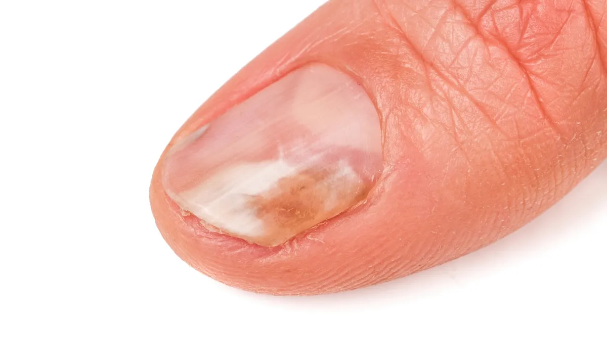 Dấu hiệu móng tay bị bệnh: Cách nhận biết sớm bạn nên biết